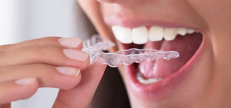 Mouthguards / Nightguards